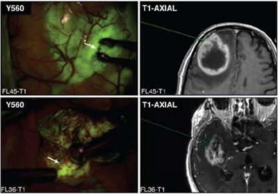 Rationale and Clinical Implications of Fluorescein-Guided Supramarginal Resection in Newly Diagnosed High-Grade Glioma